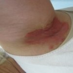 Wendy Yeast Infection