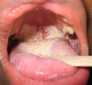 10 Tips To Crush Mouth and Throat Yeast Infections