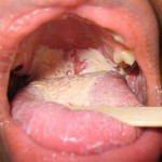 mouth yeast infection