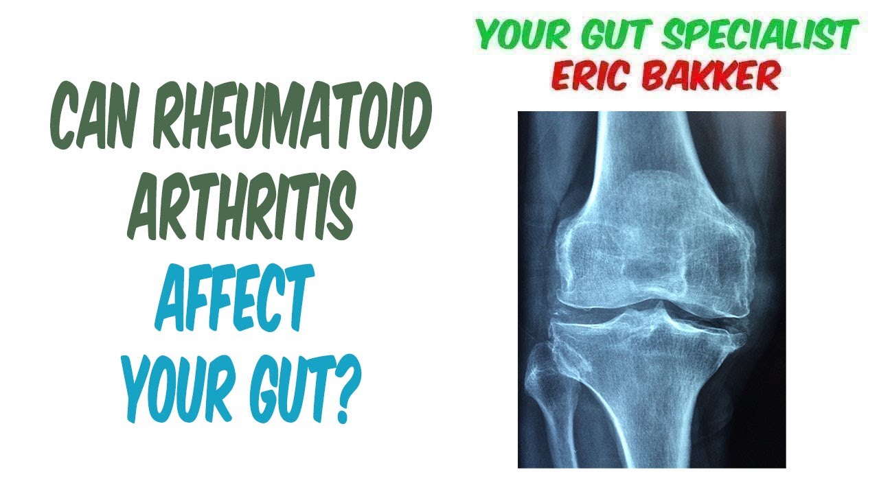 What Is The Connection Between Rheumatoid Arthritis And The Gut